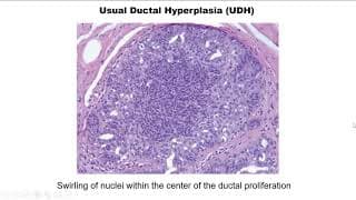 Breast Pathology Case 2