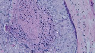 Breast Pathology Cases 3 and 4